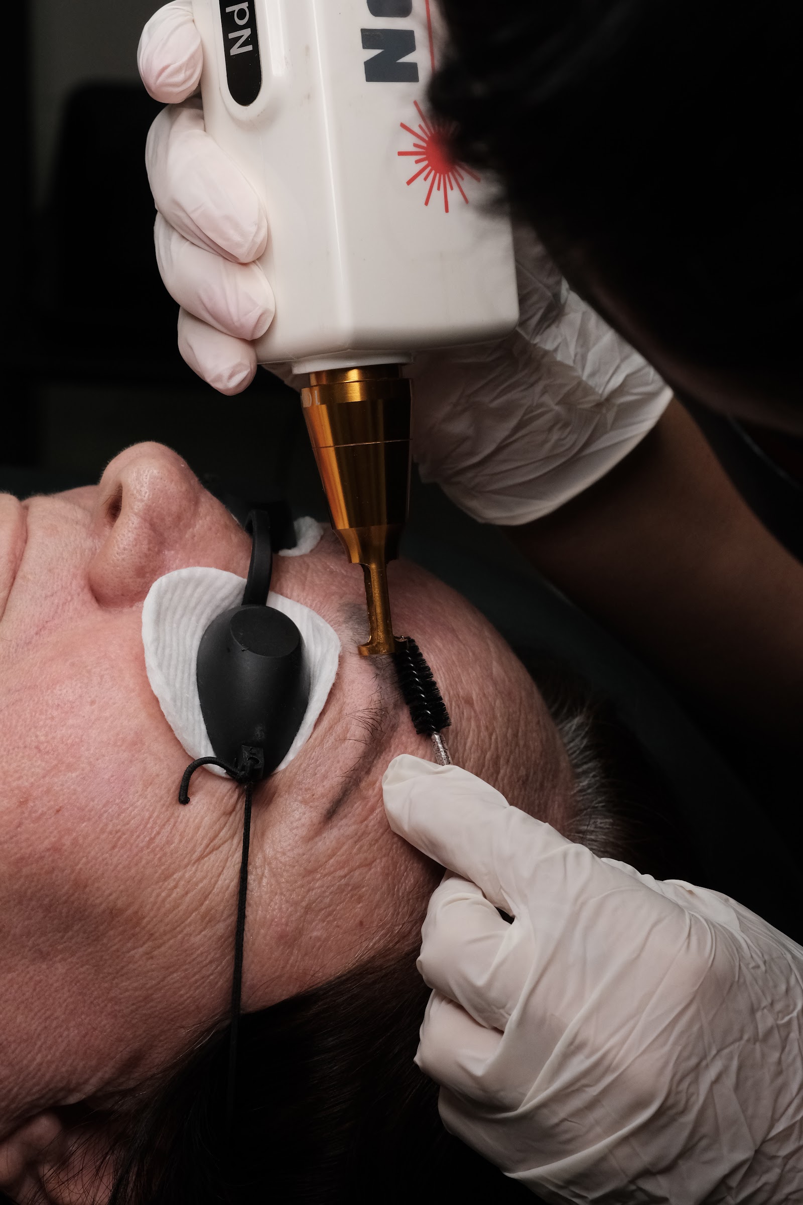 Tratamento de Melasma